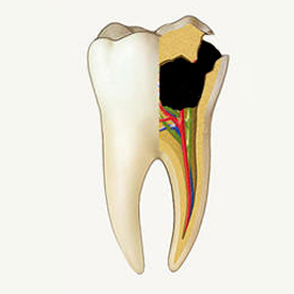 Endodontic treatment